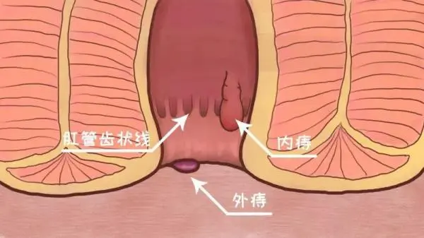 痔疮是什么原因引起的?