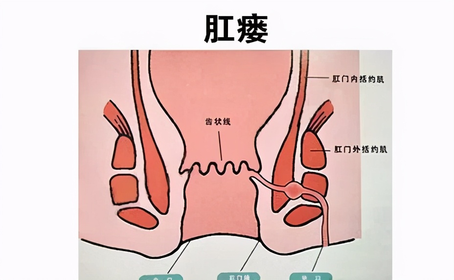 痔疮的典型症状